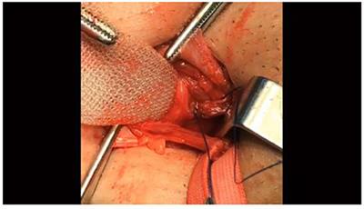 Applying Tissue and Mesh Combined Repair (TMC Repair) to Treat Adult Inguinal Hernia—A Study Based on 1,169 Cases